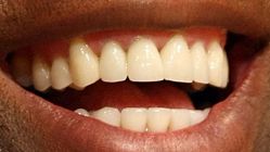 Picture of Magic Johnson teeth and smile