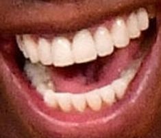 Picture of Magic Johnson teeth and smile