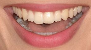 Picture of actress Margot Robbie's teeth.