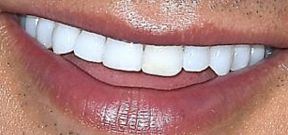 Picture of Mario Lopez's teeth and smile while smiling