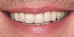 Matt Damon teeth