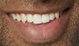Picture of Bachelor Matt James teeth and smile