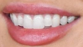 Megan Fox teeth