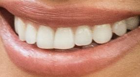 Picture of Meghan Markle teeth and smile