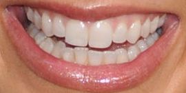 Picture of Melissa Ordway teeth and smile