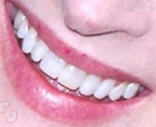 Meryl Streep teeth