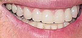 Picture of Michael Buble teeth and smile