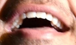Picture of Michael Ray teeth and smile
