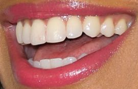 Picture of Mishael Morgan teeth and smile