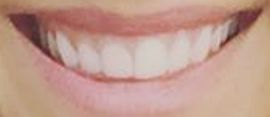 Picture of Monica Ruiz teeth and smile