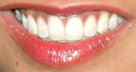 Picture of Myleene Klass teeth and smile