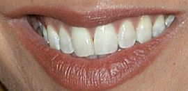 Picture of Myleene Klass teeth and smile