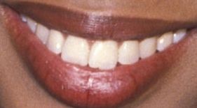 Picture of Naomi Campbell teeth and smile