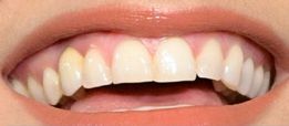 Picture of Nelly Furtado's teeth while smiling