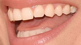 Picture of Nelly Furtado's teeth while smiling