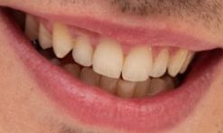 Nicholas Hoult's teeth