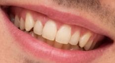 Nicholas Hoult's teeth