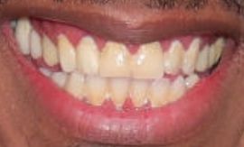 Picture of Nick Cannon teeth and smile