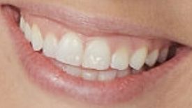 Picture of Nicole Franzel teeth and smile