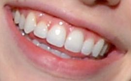 Picture of Nicole Linkletter teeth and smile