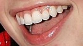Picture of Nicole Linkletter teeth and smile