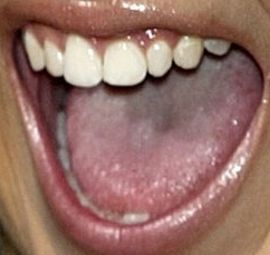Picture of Nicole Richie teeth and smile