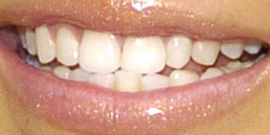 Picture of Nicole Richie teeth and smile