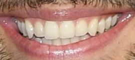 Picture of Noah Centineo teeth and smile