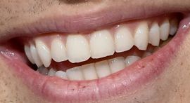 Picture of Noah Centineo teeth and smile