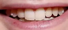 Picture of Noah Schnapp teeth and smile