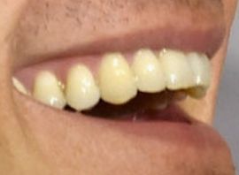 Picture of Orlando Bloom teeth and smile