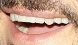 Picture of Orlando Bloom teeth and smile