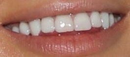 Picture of Paris Hilton teeth and smile