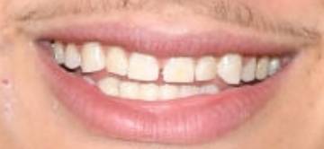 Super Bowl Stud Patrick Mahomes - Clearsmile Orthodontics