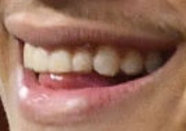 Patrick Mahomes' teeth