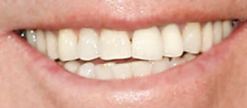 Picture of Peter Bergman teeth and smile