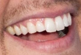 Picture of Peter Weber teeth and smile