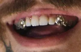 Post Malone's teeth