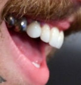 Post Malone's teeth