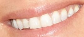 Picture of Rachel Hunter's teeth and smile