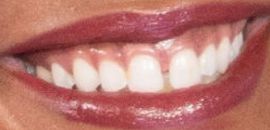 Picture of Rachel Lindsay teeth and smile