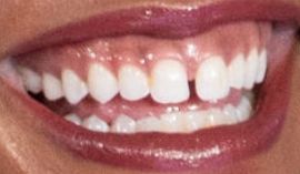Picture of Rachel Lindsay teeth and smile