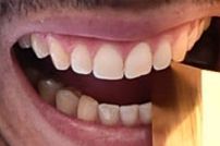 Rafael Nadal teeth