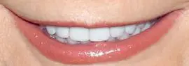 Picture of Reba McEntire teeth and smile