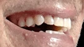 Picture of Rob Lowe teeth and smile