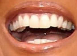 Picture of Robin Roberts teeth and smile