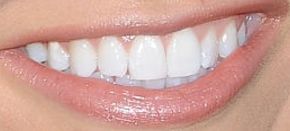 Picture of Ronda Rousey teeth and smile