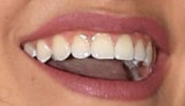 Picture of Ronni Hawk teeth and smile