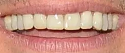 Picture Ryan Seacrest's teeth and smile