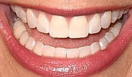 Picture of Samantha Harris teeth and smile